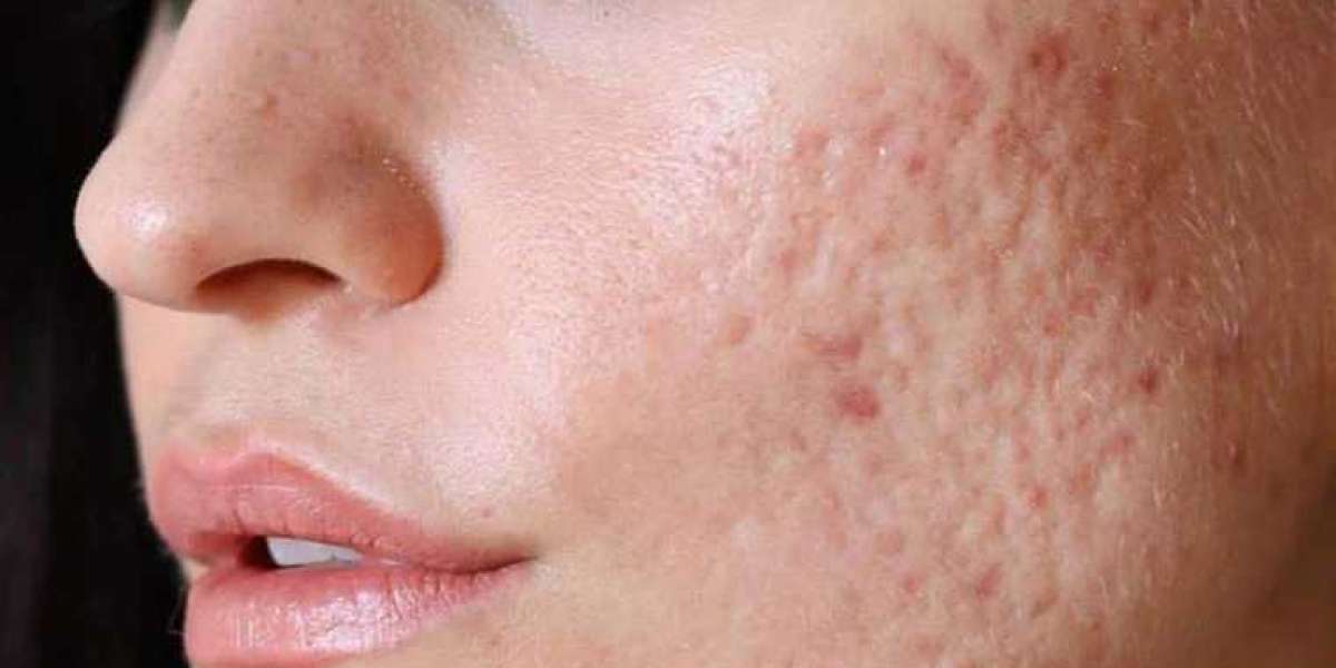 Acne Scars: Boost Confidence & Self-esteem